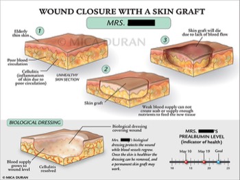  Wound Closure with Skin Graft 