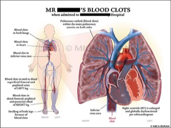  Patient's Blood Clots and DVTs 