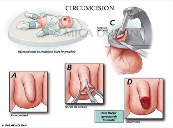  Circumcision 