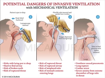  Danger of Invasive Ventilation 