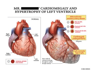  Cardiomegaly and Left-ventricluar Hypertrophy 
