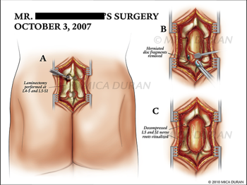  Lumbar Spine Surgery 