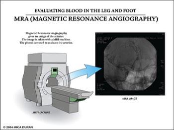 MRA: Magnetic Resonance Angiography 