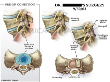  Spinal Surgery Revision 