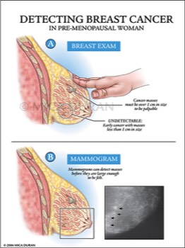  Breast Exam: Manual vs Mammogram 