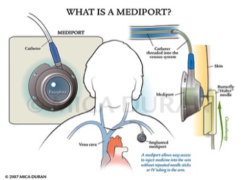  What is a Mediport 