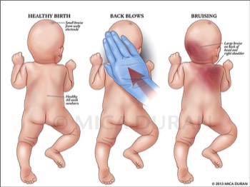  Trauma to Newborn Infant at Delivery 