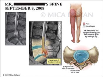  Lumbar Spine MRI 