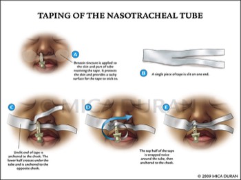  Taping of Nasotracheal Tube 