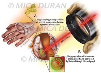  Nanoparticle Laser Retinoblastoma 