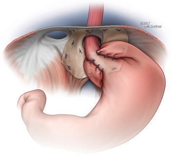  Porcine Mesh for Hiatal Hernia Repair Fundoplication 