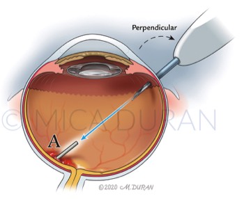  Ozurdex Injection 