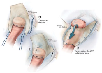  ACell Matristem Graft Placement Technique 