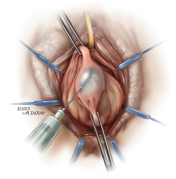  Hydrodissection Surgical Technique 